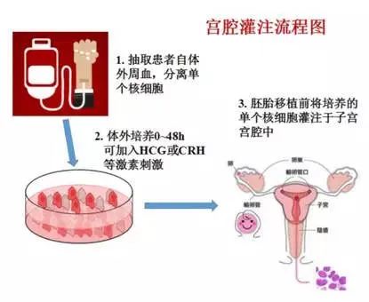 试管婴儿知识科普：试管婴儿反复移植失败的助力“神器”！宫腔灌注技术