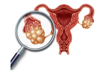 解答子宫肌瘤是什么？子宫肌瘤做试管婴儿是可以的吗？子宫肌瘤有哪些影响做试管婴儿的原因？