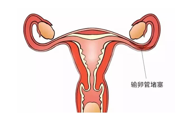 输卵管不孕怎么办？输卵管问题导致的不孕必须进行试管婴儿治疗吗？