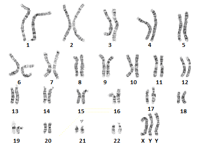 XYY性染色体异常