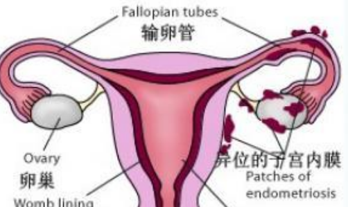 子宫内膜异位症是什么，子宫内膜异位症有哪些症状，子宫内膜异位症的治疗方法