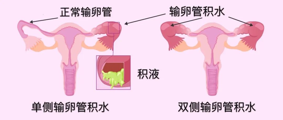 试管婴儿助孕中出现宫腔积液咋办？试管婴儿助孕中出现宫腔积液是有哪些原因造成的呢？