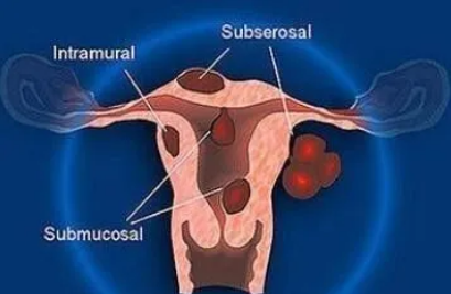 子宫肌瘤常见症状和前兆是什么？子宫肌瘤对试管婴儿有什么影响？子宫肌瘤会先手术再做试管婴儿吗？