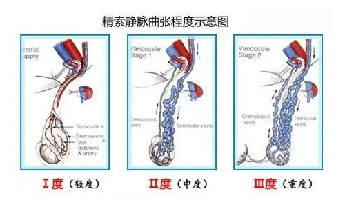 什么是精索静脉曲张？精索静脉曲张的原因有哪些？精索静脉曲张该如何治疗？精索静脉曲张可以做试管婴儿吗？