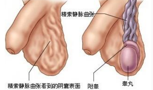 患精索静脉曲张导致男性不育该怎么治疗？精索静脉曲张的手术治疗方法？精索静脉曲张还能做试管吗？