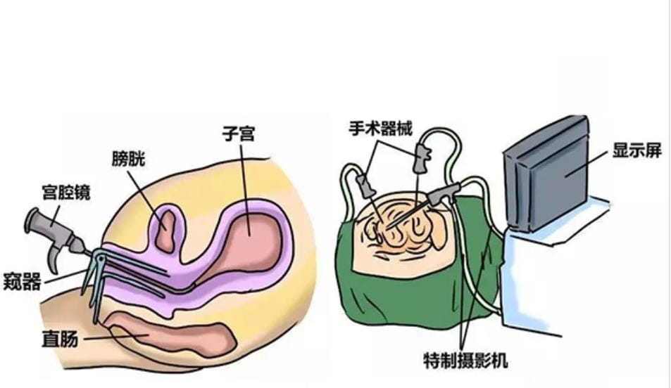 宫腔镜检查究竟是什么样子的？宫腔镜检查又具备哪些重要意义？做试管婴儿必须要宫腔镜检查？