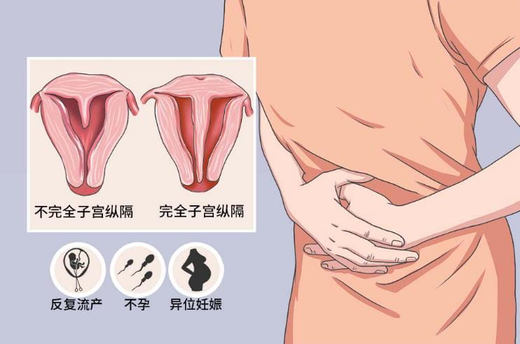 子宫畸形导致不孕不育怎么治疗？子宫畸形手术费用是多少？子宫畸形影响试管婴儿吗？