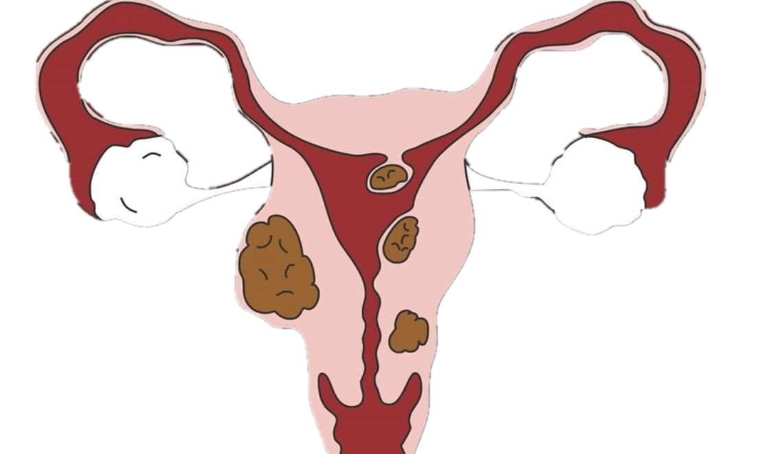 子宫肌瘤的原因有哪些？子宫肌瘤还能做试管婴儿吗？能抵抗子宫肌瘤的水果？