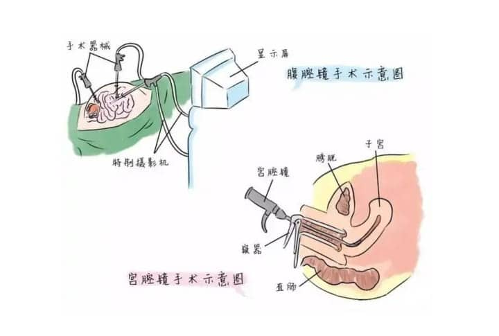 探宫是不是就是宫腔镜检查？试管移植前做探宫检查是什么意思？