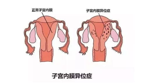 什么是子宫内膜异位症？子宫内膜异位症是否影响怀孕？国科大深圳医院的哪位医生治疗子宫内膜异位症较好？