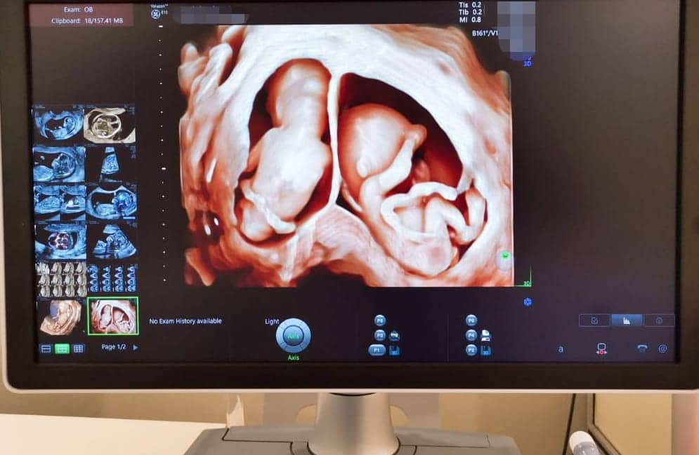 怎么通过三维彩超看男女宝宝？三维彩超看男女准确率有多少？