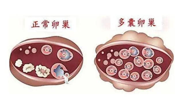 如何快速怀孕如果患有多囊卵巢综合征？怀孕初期如何保胎如果患有多囊卵巢？多囊卵巢怀孕后会出血吗？