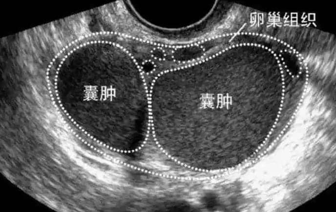 巧克力囊肿是什么病？卵巢异位囊肿如何治疗？治疗巧克力囊肿必须手术吗？