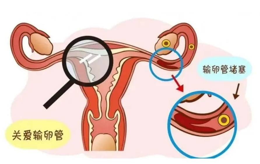 输卵管堵塞也会导致怀孕难？输卵管的检查方法有哪些？三种检查方法中那个是最最多和最常用的？