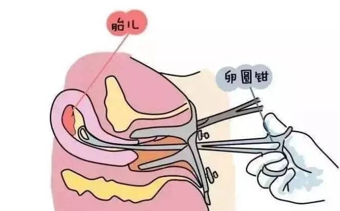 试管移植前为什么要进行子宫内膜诊刮？做试管婴儿的都要刮宫吗？试管婴儿前期的准备工作是什么？