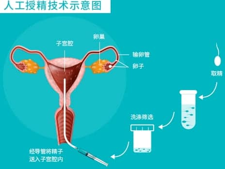 人工授精容易生化吗？哪些情况下适合做人工授精？人工授精需要哪些条件？