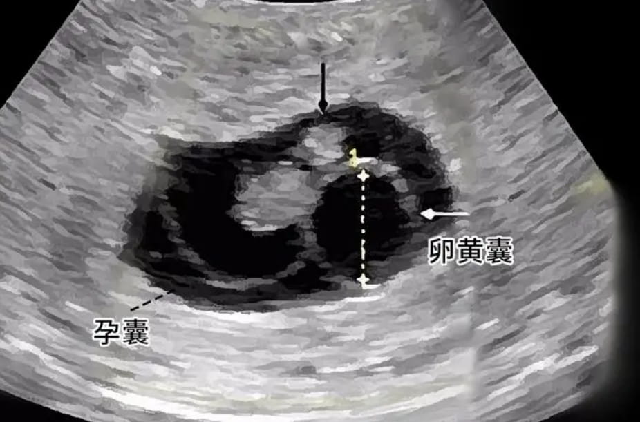 有卵黄囊了是不是就比较安全了？(b超监测有卵黄囊基本是宫内妊娠)，试管移植多少周能看到胎芽、胎心？