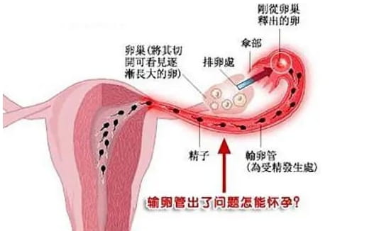 输卵管粘连不容忽视，不孕不育大部分是它的原因！河北哪家医院擅长输卵管粘连的试管方案？