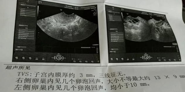 试管人群必看：为什么卵泡数≠取卵数≠胚胎数？