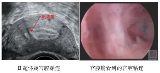 宫腔镜手术会影响怀孕吗？哪些宫腔疾病需要做宫腔镜手术？宫腔镜术前和术后注意事项有哪些？