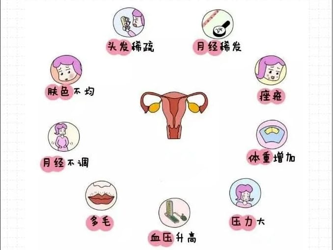 女性患有多囊卵巢的原因有哪些？多囊卵巢做腹腔镜手术治愈率更高？