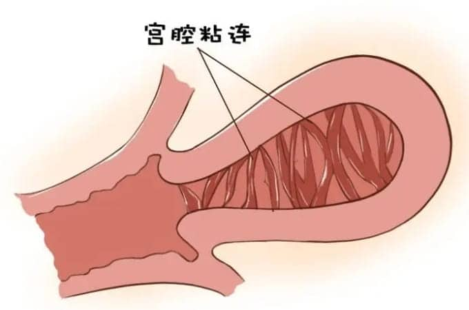 为什么会出现宫腔粘连这种情况？是哪些因素导致宫腔粘连出现？宫腔粘连还能做试管婴儿吗？