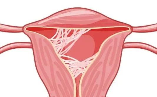 为什么会出现宫腔粘连这种情况？是哪些因素导致宫腔粘连出现？宫腔粘连还能做试管婴儿吗？