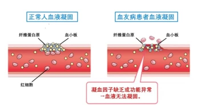 什么是血友病？血友病患者可选择三代试管婴儿技术助孕生育健康宝宝