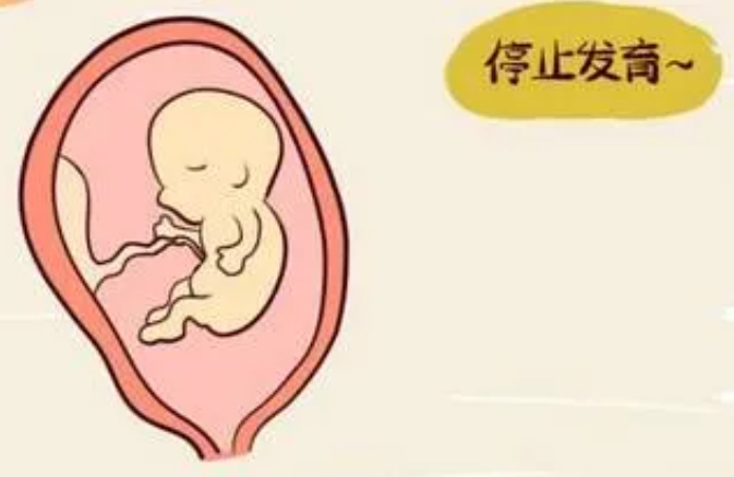 试管婴儿如何判断胎儿停止发育？试管婴儿导致胎停的原因有哪些？