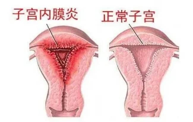 试管婴儿中慢性子宫内膜炎的诊断方法有哪些？慢性子宫内膜炎如何影响试管婴儿的成功率？