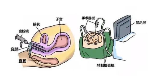试管婴儿中慢性子宫内膜炎的诊断方法有哪些？慢性子宫内膜炎如何影响试管婴儿的成功率？