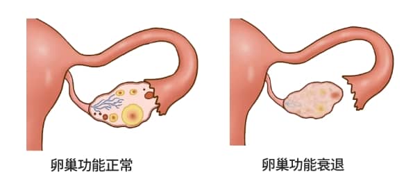 卵巢功能该如何判断？卵巢储备功能减退对生育有什么影响？卵巢功能会不会影响试管婴儿成功率？