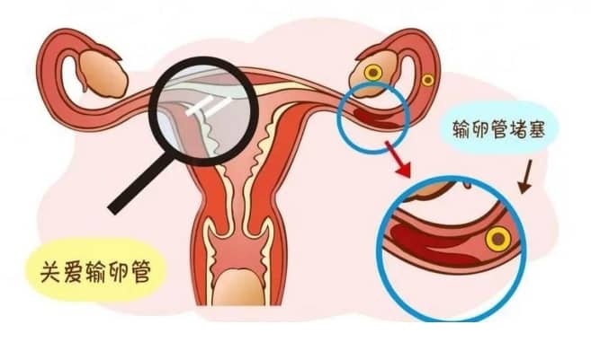 输卵管堵塞