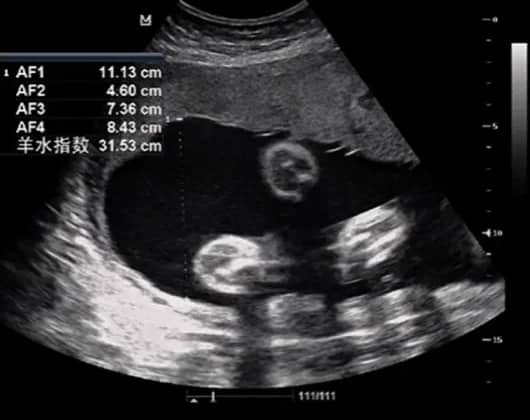 什么是基因芯片检测？基因芯片检测在试管婴儿中的应用有哪些？如何通过基因芯片检测提高试管婴儿的成功率？