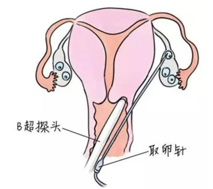 做试管婴儿什么样的卵泡才能被取？试管婴儿中B超显示的多卵泡数量与实际取到的卵子数量为什么不一致？