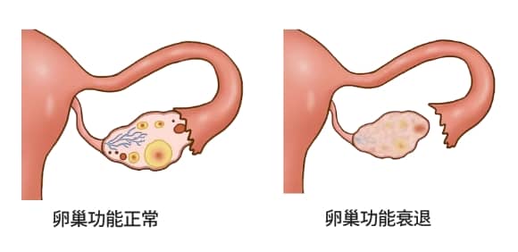 卵巢的作用是什么？试管婴儿技术能否帮助卵巢储备功能减退的女性实现生育梦想？