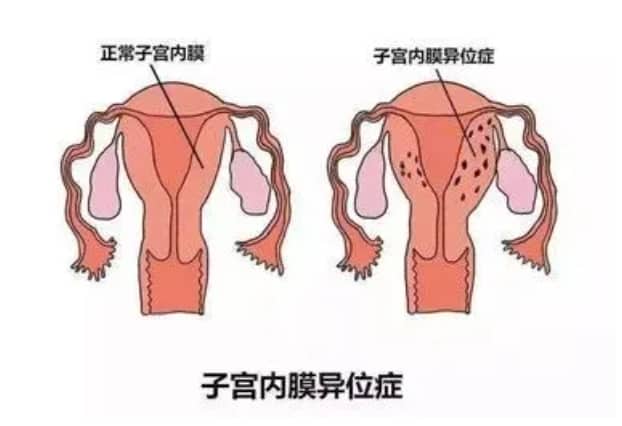 试管婴儿过程中如何科学补充铁元素以避免子宫内膜异位症相关不孕症的风险？