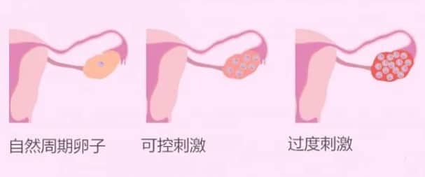试管婴儿促排卵期间患者需要注意哪些事项？试管促排期间五大注意事项助力好孕