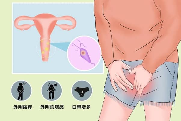 孕妈为什么易得阴道炎？试管怀孕时阴道炎来骚扰怎么办？孕期常见阴道炎及治疗方法