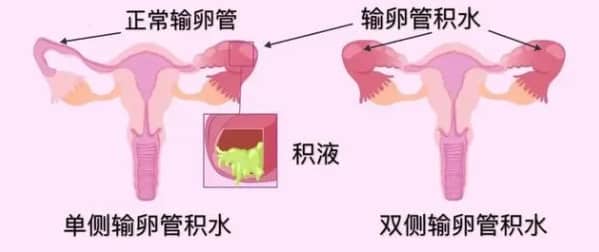 做试管婴儿前发现输卵管积水该如何处理？输卵管积水对试管婴儿成功率有何影响？