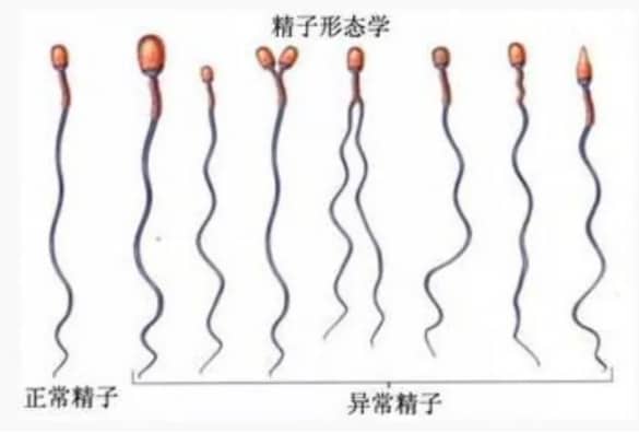 精子形态学异常会影响试管婴儿的结果吗？试管婴儿过程中精子畸形率高应该怎么办？