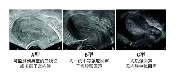 子宫内膜厚度怎么查？什么样的子宫内膜有利于怀孕？试管婴儿中什么样的子宫内膜条件最有利于胚胎着床？