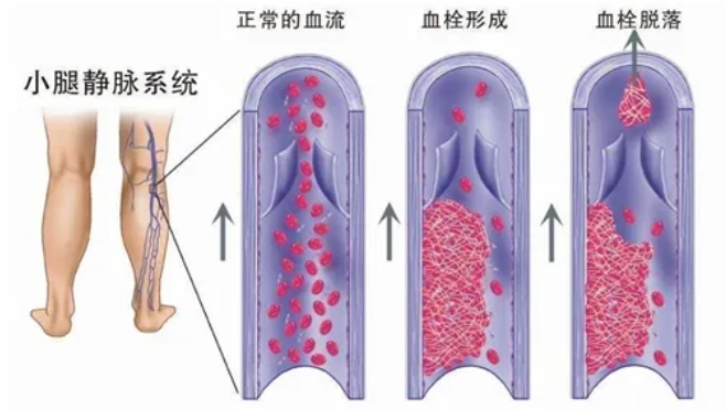 试管婴儿移植后如何正确休养以提高试管成功率？试管婴儿移植后有哪些注意事项？