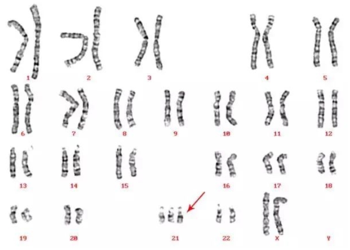 试管着床后生化妊娠究竟是由哪些因素引起的？备孕夫妻应该如何预防生化妊娠的风险？