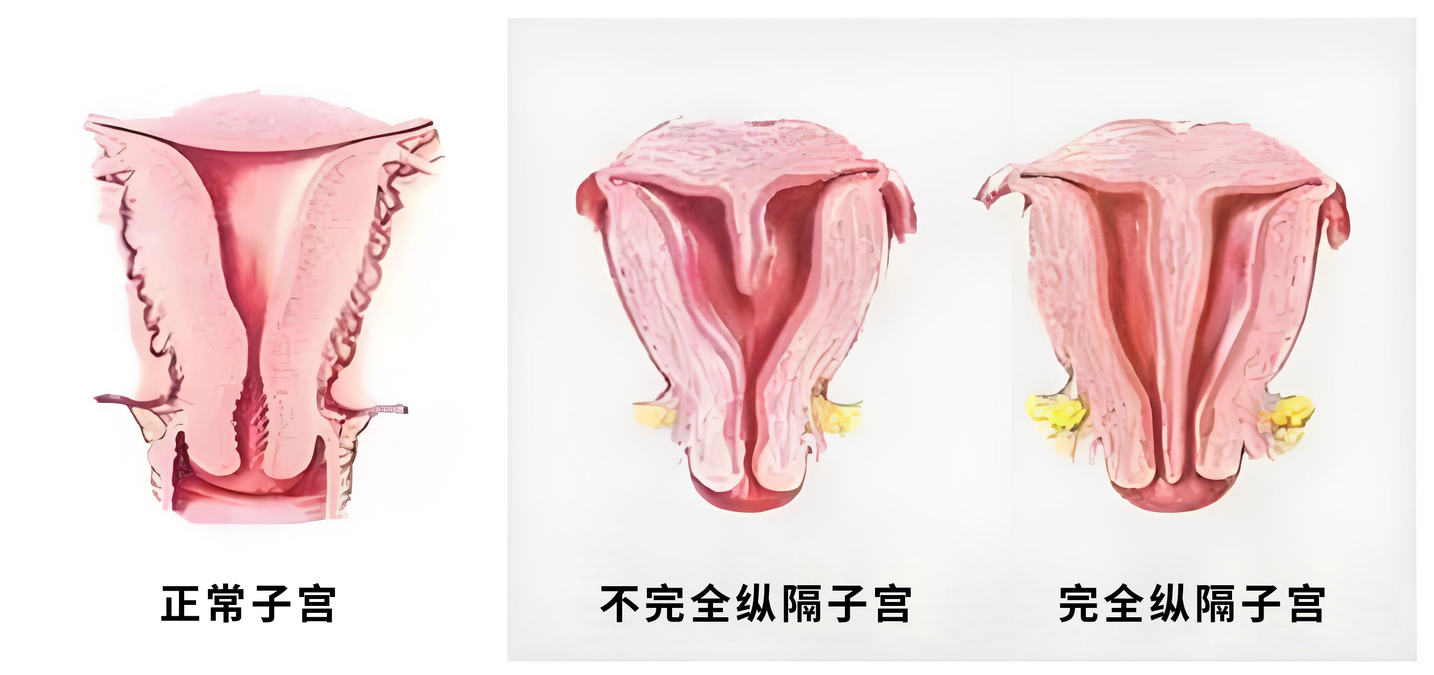  完全纵隔子宫和不完全纵隔子宫有什么区别？导致子宫纵膈的原因有哪些？纵隔子宫通过哪些检查确诊出来？