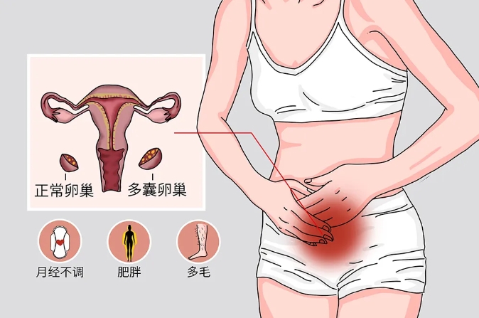 ​患有多囊的女性后代更容易患上心血管疾病吗？多囊卵巢综合征如何影响儿童的健康和发育？