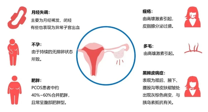 ​患有多囊的女性后代更容易患上心血管疾病吗？多囊卵巢综合征如何影响儿童的健康和发育？