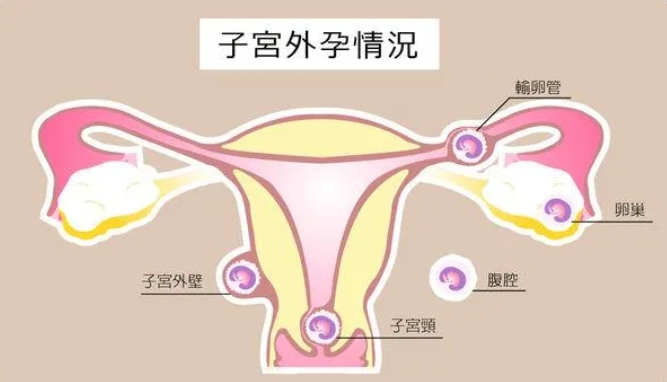 HCG升高但没翻倍胎儿真的保不住了吗？HCG翻倍不好该如何应对和处理？