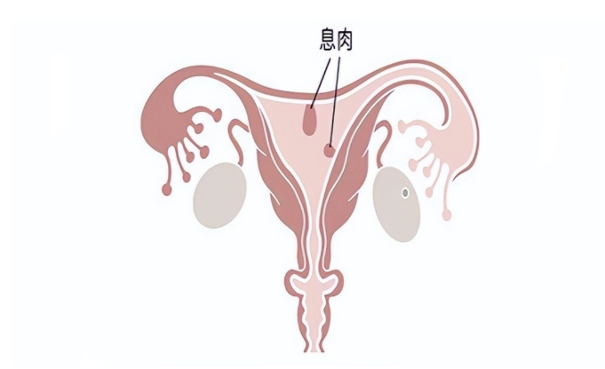 什么是子宫内膜息肉？子宫内膜息肉的病因有哪些？子宫内膜息肉会影响试管婴儿成功率吗？