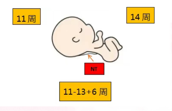 试管婴儿怀孕后做NT检查需要注意哪些事项？做NT检查常见问题有哪些？